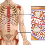 aplasticna-anemija